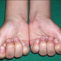 Портфолио hATTR Amyloidosis